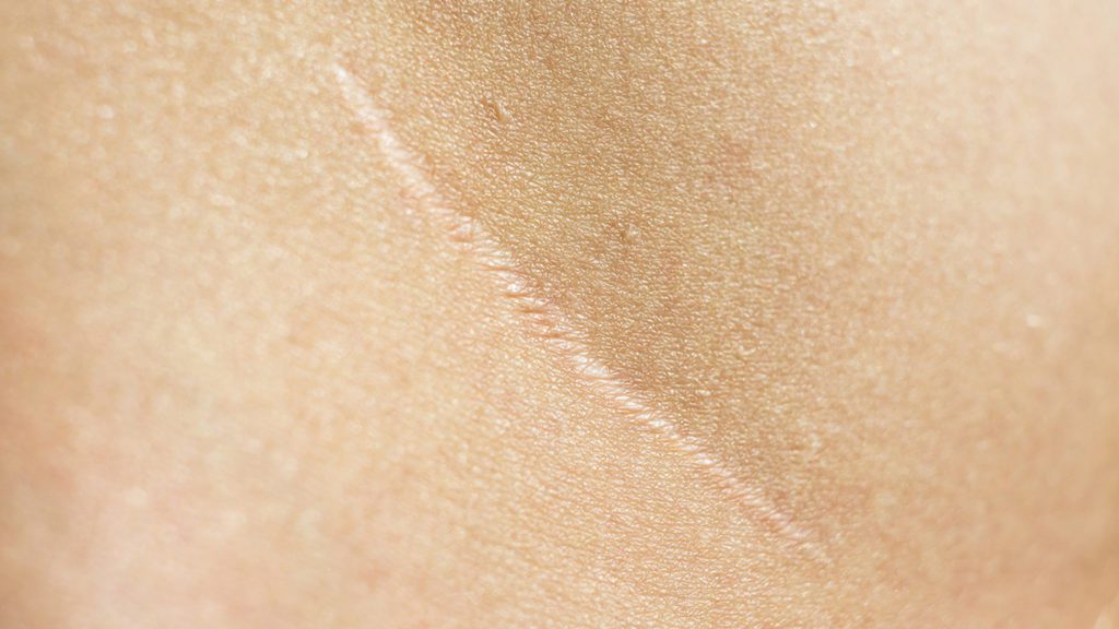 Why Silicone is Important in Optimizing Scar Healing