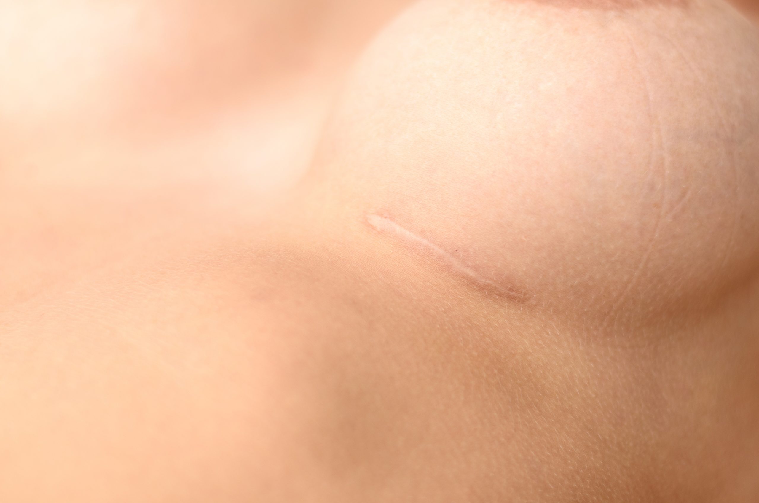 How Can You Reduce the Appearance of Scars?