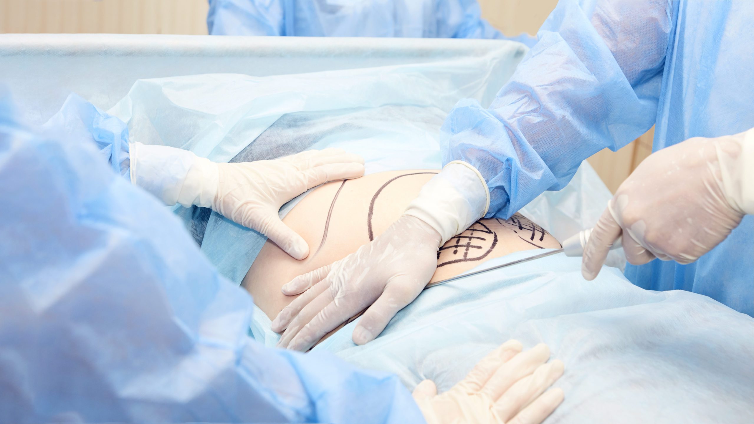 How Healfast Pre-Op and Post-Op Assists in the Ultimate Tummy Tuck Recovery